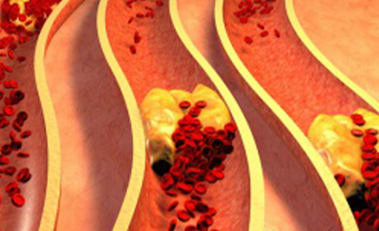 Read more about the article Dyslipidemia